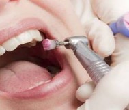 تنظيف الاسنان وازالة الجير + خطة علاجية بـ129 ريال