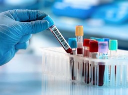 فحص فيتامين دال بـ99 ريال بدلاً من 252 ريال 