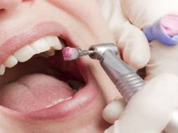 تنظيف الاسنان وازالة الجير + خطة علاجية بـ129 ريال